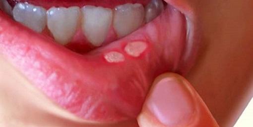 منہ کے چھالوں کا بروقت علاج ضروری ہے | Urdu News – اردو نیوز